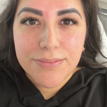 Tailored Peninsula Injectables - Before any Botox or filler - Medical Spas Near Me - Menlo Park, California