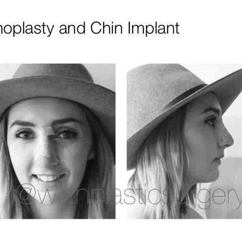 Wirth Plastic Surgery - Rhinoplasty - Cosmetic Surgeons Near Me - Newport Beach, California Wirth Plastic Surgery - Rhinoplasty - Cosmetic Surgeons Near Me - Newport Beach, California