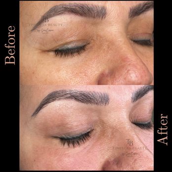 Timeless Beauty - Acne Treatment Near Me - Downey, California Timeless Beauty - Acne Treatment Near Me - Downey, California
