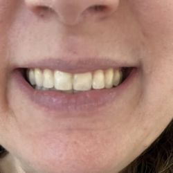 Silva Orthodontics - Buttons removed and perfect smile activated!