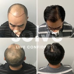 Solve Clinics - FUE (2000 grafts) + 1 PRP
Solve is the highest rated hair loss clinic in Chicago. Contact us for a free hair loss consultation and price.