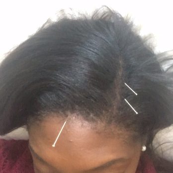 Longevity Acupuncture - Acupuncture Near Me - South Miami, Florida