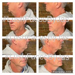 ERA Wellness Spa - Kybella Treatment at Lush Aesthetics