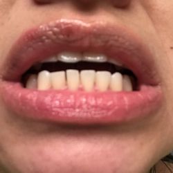 Westview Dental Center and Fastbraces - Irregular and excessive unnecessary shaving of lower teeth.