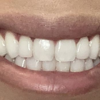 Nick Addario, DDS - After Invisalign and porcelain veneers - Cosmetic Dentists Near Me - Chula Vista, California Nick Addario, DDS - After Invisalign and porcelain veneers - Cosmetic Dentists Near Me - Chula Vista, California