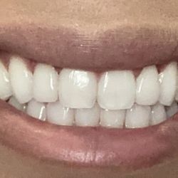 Nick Addario, DDS - After Invisalign and porcelain veneers