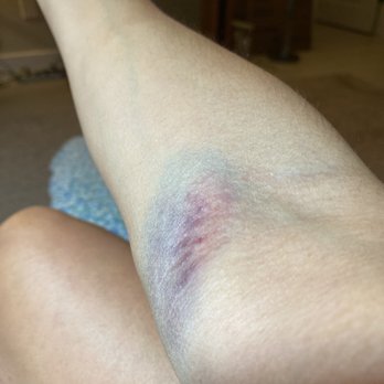 Quest Diagnostics - Hematoma from quest 969 E Commercial - Laboratory Testing Near Me - Oakland Park, Florida Quest Diagnostics - Hematoma from quest 969 E Commercial - Laboratory Testing Near Me - Oakland Park, Florida