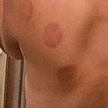 Evolve Chiropractic Of St Charles - Cupping - Ancient technique to increase blood flow to release pain and inflammation. Slight bruising after although procedure dosen't hurt. - Chiropractors Near Me - St. Charles, Illinois Evolve Chiropractic Of St Charles - Cupping - Ancient technique to increase blood flow to release pain and inflammation. Slight bruising after although procedure dosen't hurt. - Chiropractors Near Me - St. Charles, Illinois