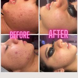 KM Esthetics - Acne treatment