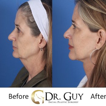 Dr Guy Facial Plastic Surgery - Deep plane facelift - Plastic Surgeons Near Me - Conroe, Texas