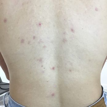 La Jolla Acne Specialists - Pre-treatment - Acne Treatment Near Me - San Diego, California La Jolla Acne Specialists - Pre-treatment - Acne Treatment Near Me - San Diego, California