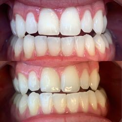 Illuminate Teeth Whitening