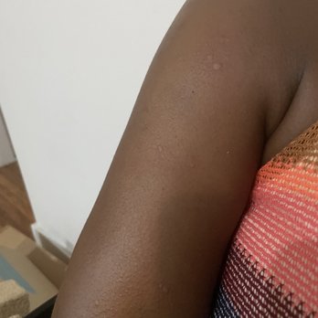 Risbo - Hives near shoulder and upper arm. Allergic reaction to The Healthy One that has always been nut-free - French Near Me - Brooklyn, New York Risbo - Hives near shoulder and upper arm. Allergic reaction to The Healthy One that has always been nut-free - French Near Me - Brooklyn, New York