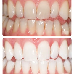 Glenbard Family Dental - Special event coming up or just looking to brighten your smile? We offer ZOOM! Bleaching.