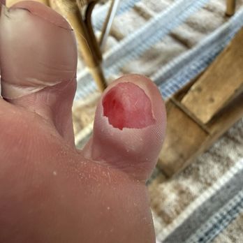 Nails 2000 Plus - 2nd degree burn - Nail Salons Near Me - Carlsbad, California