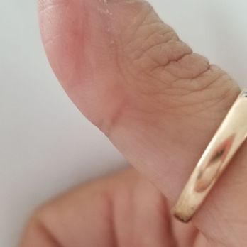 FastMed Urgent Care - Thumb pictures before and after. - Doctors Near Me - Cary, North Carolina FastMed Urgent Care - Thumb pictures before and after. - Doctors Near Me - Cary, North Carolina