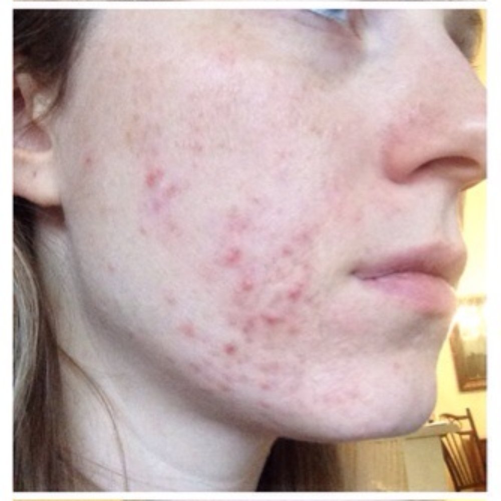 KWest Esthetics - During treatments. I think this is after 2 acid peels. Sometimes it gets worse before it gets better.... Have to stick with it!! - Skin Care Near Me - Mesa, Arizona KWest Esthetics - During treatments. I think this is after 2 acid peels. Sometimes it gets worse before it gets better.... Have to stick with it!! - Skin Care Near Me - Mesa, Arizona