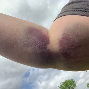 BioLife Plasma Services - Blood & Plasma Donation Centers Near Me - Denton, Texas BioLife Plasma Services - Blood & Plasma Donation Centers Near Me - Denton, Texas