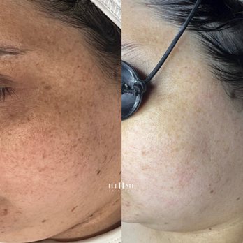 Illume Skin Spa - IPL Before and After - Waxing Near Me - Stoneham, Massachusetts Illume Skin Spa - IPL Before and After - Waxing Near Me - Stoneham, Massachusetts