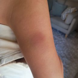 A bruise on her arm by the massage lady stepping on her. A bruise on her arm by the massage lady stepping on her.