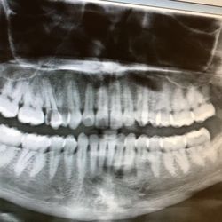 Anthony TR Green, DDS - Tooth extraction, top left. Tooth that looks like a sea-shell.