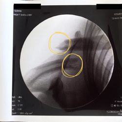 Mark Lawler, MD - Does this fracture look like fun?? #agony