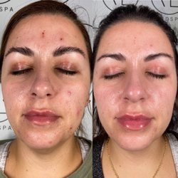 Vanity Lab Med Spa - Two week difference! Amazing!!