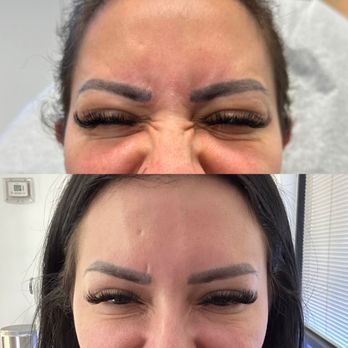 Oresmie Aesthetics - "bunny line" treatment - Medical Spas Near Me - Payson, Arizona Oresmie Aesthetics - "bunny line" treatment - Medical Spas Near Me - Payson, Arizona