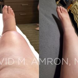 Before and 2 months post-op,  for Stage 3 Lipolymphedema, a condition where both progressive Lipedema and resulting Lymphedema are present.