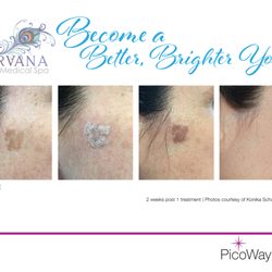 Nirvana Medical Spa - Get rid of unsightly melasma in Ocala Florida at nirvana Medical Spa!