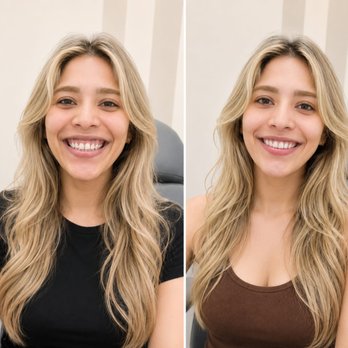 VIBEology Medspa - Gummy smile Botox before & after for a softer, more confident smile. - Medical Spas Near Me - Prosper, Texas VIBEology Medspa - Gummy smile Botox before & after for a softer, more confident smile. - Medical Spas Near Me - Prosper, Texas