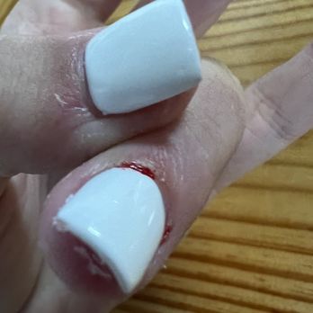 City Nails & Spa - Swollen and bloody cuticle - Nail Salons Near Me - Athens, Georgia City Nails & Spa - Swollen and bloody cuticle - Nail Salons Near Me - Athens, Georgia