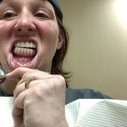 DDS Dentures + Implant Solutions of Denton - Bite doesn't line up at all 3 years after initial surgery.