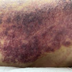 Huntsville Cardiovascular Clinic - Massive brusing from hematoma