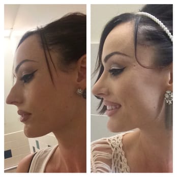 Mehta Plastic Surgery - Left is before and right is 1 month post op - Cosmetic Surgeons Near Me - Menlo Park, California