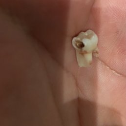 Tooth cavity Tooth cavity