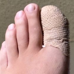 The Podiatry Boutique - My carefully bandaged toe after ingrown toenail procedure.