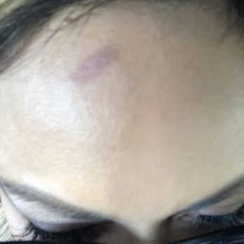 Primp and Blow - West University - Burnt forehead from a curling iron - Blow Dry/Out Services Near Me - Houston, Texas Primp and Blow - West University - Burnt forehead from a curling iron - Blow Dry/Out Services Near Me - Houston, Texas