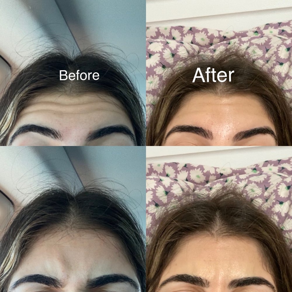 Before and after 22 units of Botox Before and after 22 units of Botox