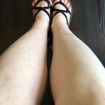 Revelus Dermatology - My legs not covered in psoriasis - Dermatologists Near Me - Austin, Texas Revelus Dermatology - My legs not covered in psoriasis - Dermatologists Near Me - Austin, Texas
