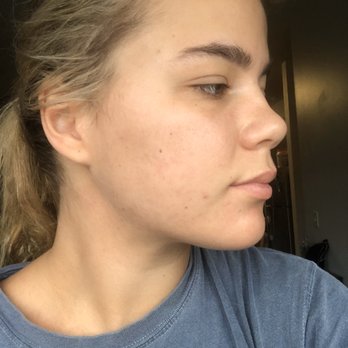 Atlanta Acne Specialists - APRIL 2020 - Skin Care Near Me - Decatur, Georgia