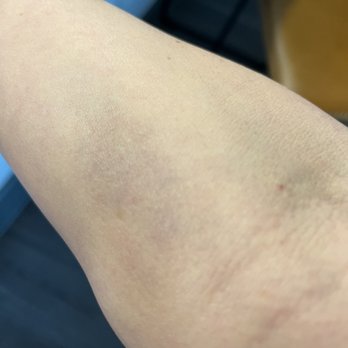 Quest Diagnostics - Day 2 You can see the point of entry on my crease, middle of my arm. Notice the bruise forming on my arm. - Laboratory Testing Near Me - Sarasota, Florida