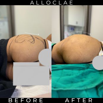 Matthew J Nykiel, MD - Alloclae Fat Transfer Hip Dip Before and After - Plastic Surgeons Near Me - Upland, California Matthew J Nykiel, MD - Alloclae Fat Transfer Hip Dip Before and After - Plastic Surgeons Near Me - Upland, California