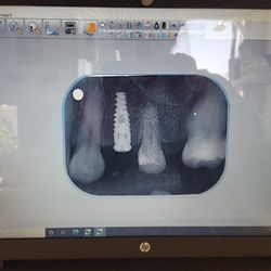 Dental 4 - Implants