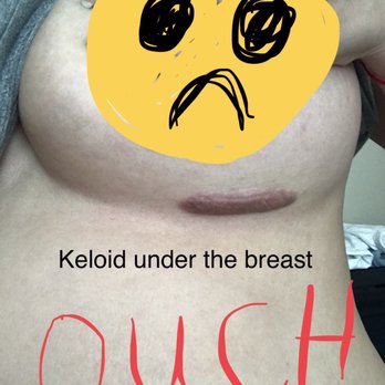 Brian M Braithwaite, MD - Most painful scar ever!! - Cosmetic Surgeons Near Me - Chicago, Illinois
