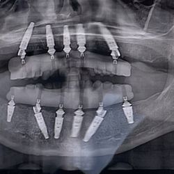 Smart Dental & Implant Center - My implants!
