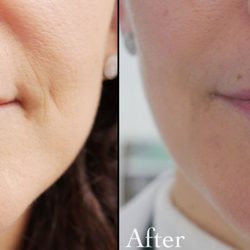 M C Medical Group - Before-After of Dermal Fillers