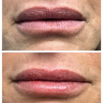 Beautify By Karin - Before and after 1cc Juvederm Ultra Plus - Medical Spas Near Me - Glendale, California Beautify By Karin - Before and after 1cc Juvederm Ultra Plus - Medical Spas Near Me - Glendale, California