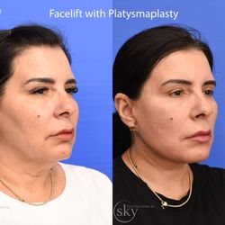 SKY Facial Plastic Surgery - Lower face and neck lift - Right Lateral View
