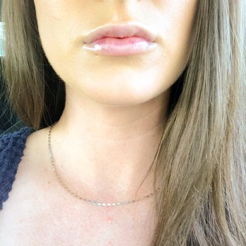 Flawless Med Spa - Day 2, minimal bruising and not much swelling. - Skin Care Near Me - La Verne, California